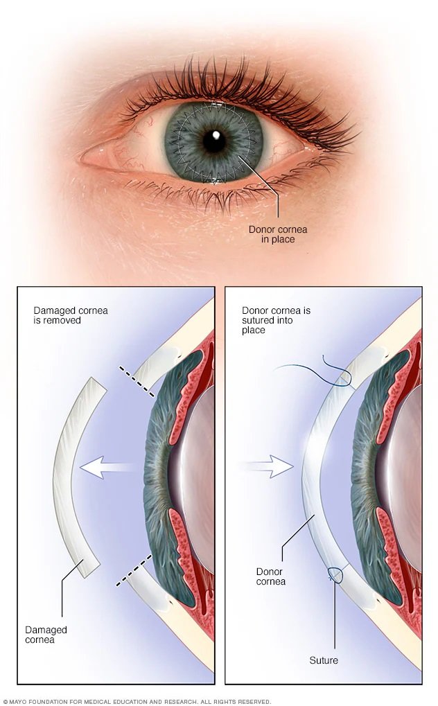cornealtransplant