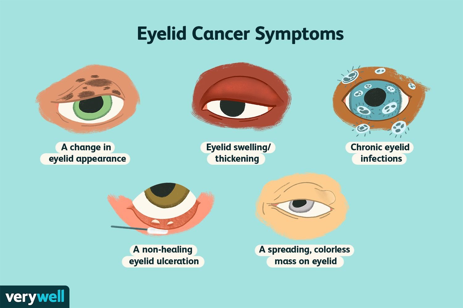 eyelidcancer