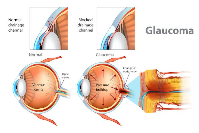glaucoma